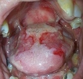 Lesiones ulcerativas en cara dorsal de la lengua,
bordes linguales, paladar blando y mucosa yugal