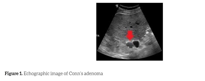 Echographic image
of Conn’s adenoma