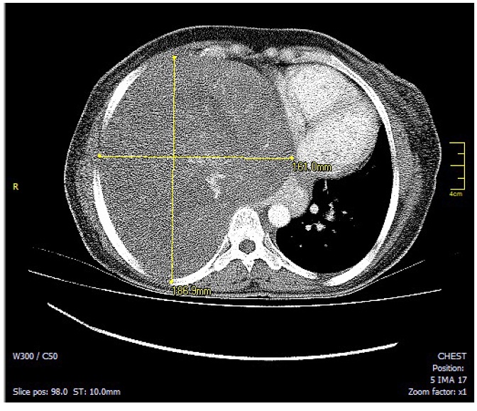 Corte axial en tomografía computarizada de tórax con
contraste