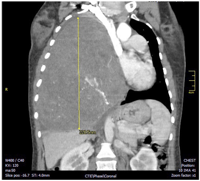Corte coronal en tomografía computarizada de tórax con
contraste