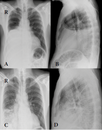 Radiografía de tórax: en la proyección posterior anterior se evidencia opacidad en el tercio interior del hemitórax izquierdo con borramiento del hemidiafragma con ascenso pulmonar ipsilateral (A). En la proyección lateral (B) se visualiza opacidad en 2/3 del hemitórax. En (C) se observa aumento de la silueta pulmonar y del diámetro pulmonar con presencia de nódulos y posible afectación de los tejidos adyacentes. (D) Hay expansión pulmonar con presencia de consolidación aparentemente paraneumónica