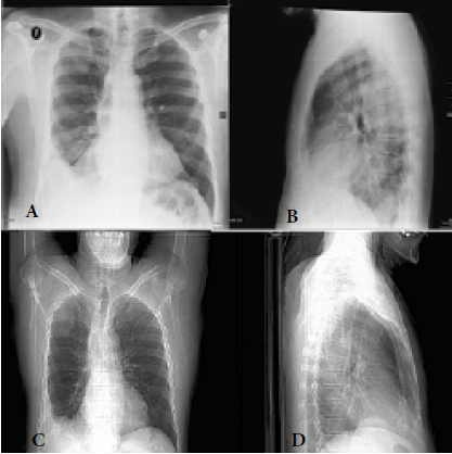 Radiografía de tórax (A y B). Se observa engrosamiento pleural con consolidación unilateral en el ángulo costo-diafragmático y desplazamiento mediastinal, con visualización de la rama bronquial aparentemente normal. (C y D) Se detalla un aumento del espacio intrapulmonar con evidencia de múltiples consolidaciones en el ápice pulmonar y en el ángulo costo-diafragmático derecho con desplazamiento del mediastino posterior. Pulmón izquierdo aparentemente normal