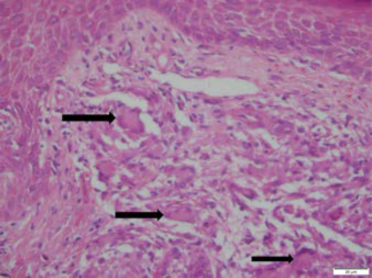 Biopsia de nódulos en región pretibial (40X. Coloración de hematoxilina-eosina h/e). Se reconocen múltiples células gigantes multinucleadas (flechas) que se acompañan de histiocitos que conforman varios granulomas epitelioides sin necrosis de caseificación. Algunos de ellos se agrupan espalda a espalda. Nótense las ectasias vasculares y la paniculitis septal