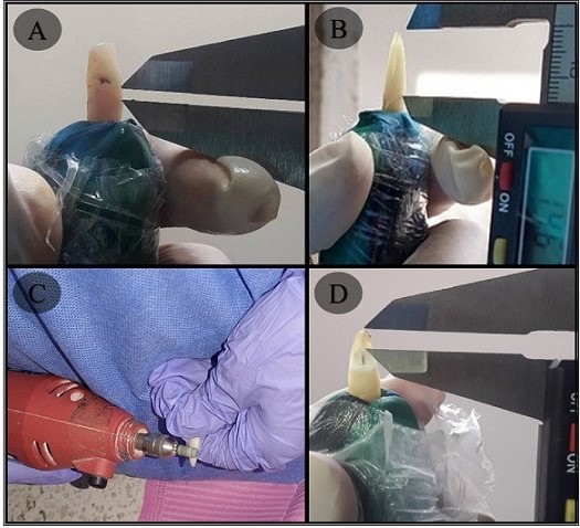 Procedimientos para obtener los indicadores para las fórmulas de cada método empleado A Medición de la altu ra máxima de la periodontosis B Medición de la altura radicular máxima C Desgaste radicular D Medición de la longitud máxima de la transparencia radicular